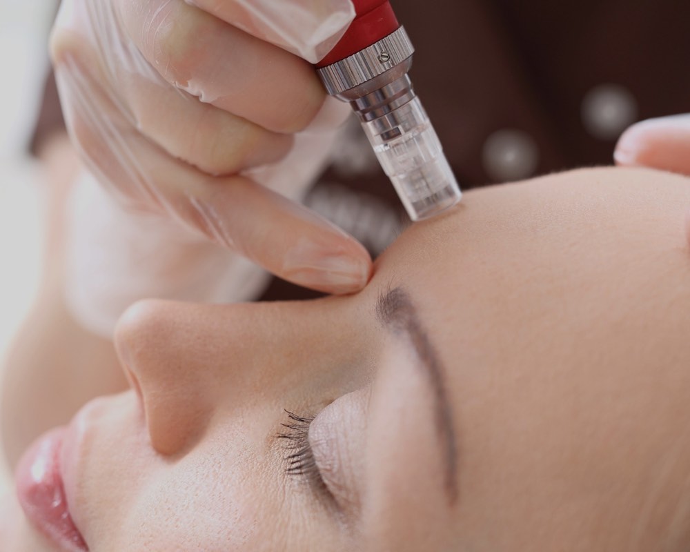 What is RF Microneedling and Why Do You Need It?